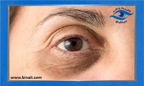 روش های رفع گودی و سیاهی زیر چشم