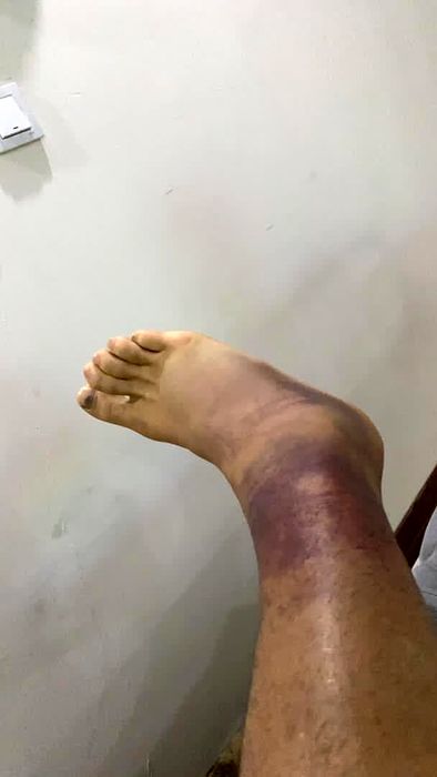 مدافع پرسپولیس غایب بزرگ دربی تهران؟ / عکس