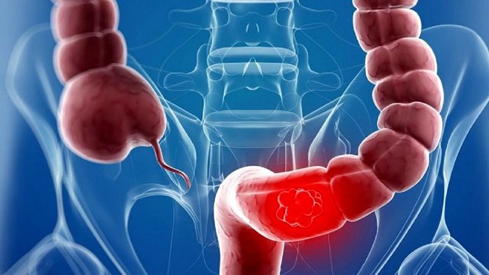 نشانه جدی بیماری سرطان روده‌